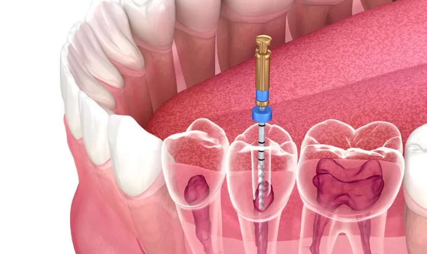 Root Canal Treatment Effective for Dental Abscess